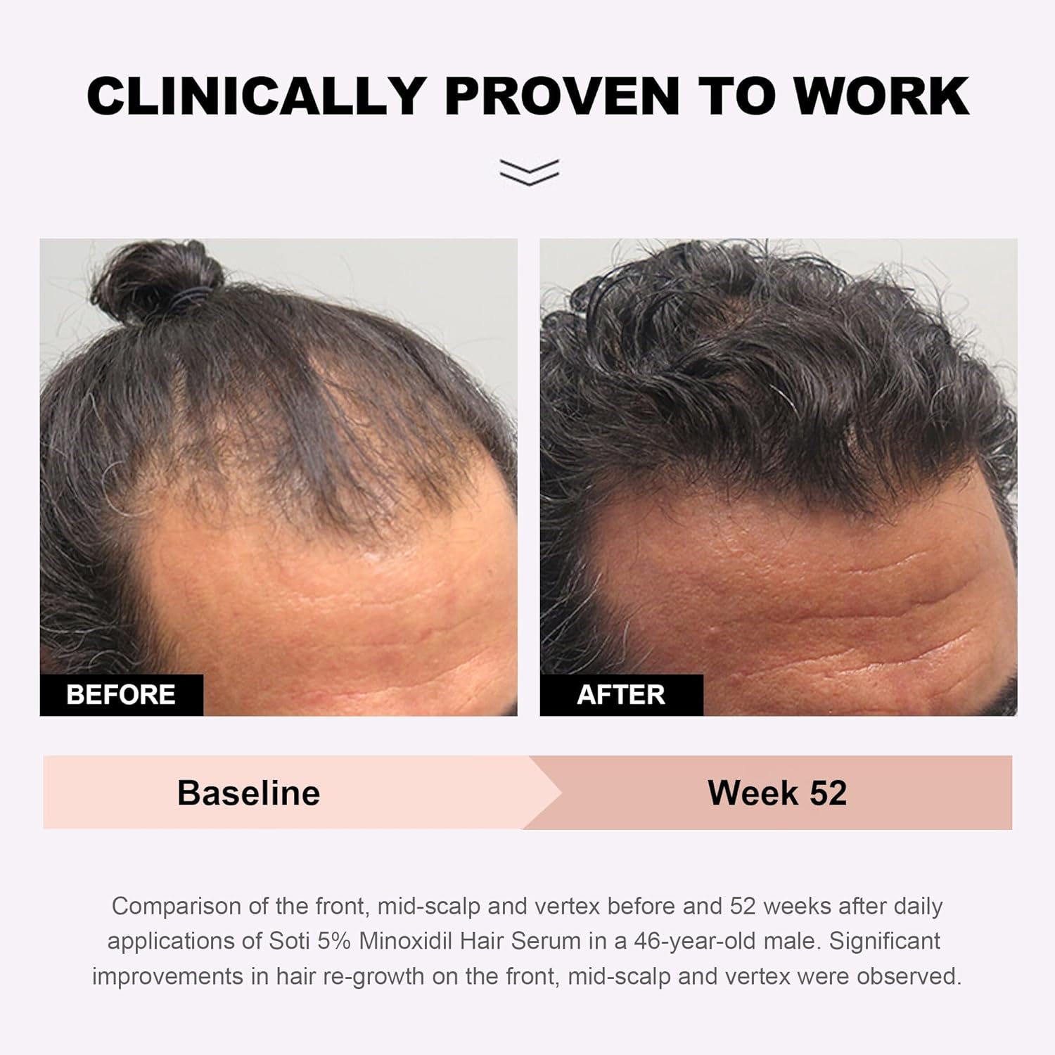 Soti Minoxidil 5% Hair Growth, Hair Loss Regrowth Serum. Made in USA! Dermatologists Recommended. Ginseng and Biotin Extra Strength Formula. (1 Pack)